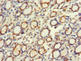 Immunohistochemistry of paraffin-embedded human gastric cancer using CAC14571 at dilution of 1:100 Immunohistochemistry of paraffin-embedded human gastric cancer using CAC14571 at dilution of 1:100