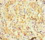 Immunohistochemistry of paraffin-embedded human lung cancer using CAC14575 at dilution of 1:100 Immunohistochemistry of paraffin-embedded human lung cancer using CAC14575 at dilution of 1:100
