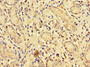 Immunohistochemistry of paraffin-embedded human gastric cancer using CAC14587 at dilution of 1:100 Immunohistochemistry of paraffin-embedded human gastric cancer using CAC14587 at dilution of 1:100