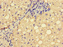 Immunohistochemistry of paraffin-embedded human liver cancer using CAC14587 at dilution of 1:100 Immunohistochemistry of paraffin-embedded human liver cancer using CAC14587 at dilution of 1:100