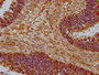 IHC image of CAC14594 diluted at 1:1000 and staining in paraffin-embedded human ovarian cancer performed on a Leica BondTM system. After dewaxing and hydration, antigen retrieval was mediated by high pressure in a citrate buffer (pH 6.0). Section was blocked with 10% normal goat serum 30min at RT. Then primary antibody (1% BSA) was incubated at 4°C overnight. The primary is detected by a biotinylated secondary antibody and visualized using an HRP conjugated SP system. IHC image of CAC14594 diluted at 1:1000 and staining in paraffin-embedded human ovarian cancer performed on a Leica BondTM system. After dewaxing and hydration, antigen retrieval was mediated by high pressure in a citrate buffer (pH 6.0). Section was blocked with 10% normal goat serum 30min at RT. Then primary antibody (1% BSA) was incubated at 4°C overnight. The primary is detected by a biotinylated secondary antibody and visualized using an HRP conjugated SP system.