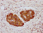 IHC image of CAC14594 diluted at 1:1000 and staining in paraffin-embedded human pancreatic cancer performed on a Leica BondTM system. After dewaxing and hydration, antigen retrieval was mediated by high pressure in a citrate buffer (pH 6.0). Section was blocked with 10% normal goat serum 30min at RT. Then primary antibody (1% BSA) was incubated at 4°C overnight. The primary is detected by a biotinylated secondary antibody and visualized using an HRP conjugated SP system. IHC image of CAC14594 diluted at 1:1000 and staining in paraffin-embedded human pancreatic cancer performed on a Leica BondTM system. After dewaxing and hydration, antigen retrieval was mediated by high pressure in a citrate buffer (pH 6.0). Section was blocked with 10% normal goat serum 30min at RT. Then primary antibody (1% BSA) was incubated at 4°C overnight. The primary is detected by a biotinylated secondary antibody and visualized using an HRP conjugated SP system.