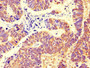 Immunohistochemistry of paraffin-embedded human ovarian cancer using CAC14598 at dilution of 1:100
