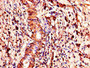 Immunohistochemistry of paraffin-embedded human gastric cancer using CAC14617 at dilution of 1:100
