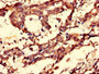 Immunohistochemistry of paraffin-embedded human gastric cancer using CAC14633 at dilution of 1:100