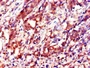 Immunohistochemistry of paraffin-embedded human gastric cancer using CAC14643 at dilution of 1:100