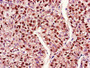 Immunohistochemistry of paraffin-embedded human liver cancer using CAC14644 at dilution of 1:100