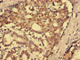 Immunohistochemistry analysis of human breast cancer using CAC14650 at dilution of 1:100