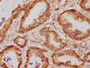 IHC image of CAC14696 diluted at 1:300 and staining in paraffin-embedded human colon cancer performed on a Leica BondTM system. After dewaxing and hydration, antigen retrieval was mediated by high pressure in a citrate buffer (pH 6.0). Section was blocked with 10% normal goat serum 30min at RT. Then primary antibody (1% BSA) was incubated at 4°C overnight. The primary is detected by a biotinylated secondary antibody and visualized using an HRP conjugated SP system.
