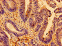 Immunohistochemistry of paraffin-embedded human colon cancer using CAC14704 at dilution of 1:100 Immunohistochemistry of paraffin-embedded human colon cancer using CAC14704 at dilution of 1:100