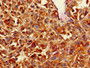 Immunohistochemistry of paraffin-embedded human melanoma using CAC14714 at dilution of 1:100 Immunohistochemistry of paraffin-embedded human melanoma using CAC14714 at dilution of 1:100