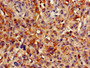 Immunohistochemistry of paraffin-embedded human melanoma using CAC14727 at dilution of 1:100 Immunohistochemistry of paraffin-embedded human melanoma using CAC14727 at dilution of 1:100