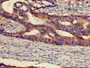 IHC image of CAC14738 diluted at 1:300 and staining in paraffin-embedded human colon cancer performed on a Leica BondTM system. After dewaxing and hydration, antigen retrieval was mediated by high pressure in a citrate buffer (pH 6.0). Section was blocked with 10% normal goat serum 30min at RT. Then primary antibody (1% BSA) was incubated at 4°C overnight. The primary is detected by a biotinylated secondary antibody and visualized using an HRP conjugated SP system. IHC image of CAC14738 diluted at 1:300 and staining in paraffin-embedded human colon cancer performed on a Leica BondTM system. After dewaxing and hydration, antigen retrieval was mediated by high pressure in a citrate buffer (pH 6.0). Section was blocked with 10% normal goat serum 30min at RT. Then primary antibody (1% BSA) was incubated at 4°C overnight. The primary is detected by a biotinylated secondary antibody and visualized using an HRP conjugated SP system.