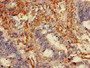 Immunohistochemistry of paraffin-embedded human colon cancer using CAC14740 at dilution of 1:100 Immunohistochemistry of paraffin-embedded human colon cancer using CAC14740 at dilution of 1:100