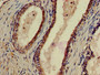 Immunohistochemistry of paraffin-embedded human prostate cancer using CAC14745 at dilution of 1:100