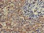 Immunohistochemistry of paraffin-embedded human liver cancer using CAC14763 at dilution of 1:100 Immunohistochemistry of paraffin-embedded human liver cancer using CAC14763 at dilution of 1:100