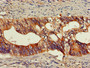 Immunohistochemistry of paraffin-embedded human colon cancer using CAC14792 at dilution of 1:100