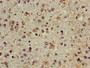 Immunohistochemistry of paraffin-embedded human glioma using CAC14803 at dilution of 1:100 Immunohistochemistry of paraffin-embedded human glioma using CAC14803 at dilution of 1:100