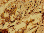 Immunohistochemistry of paraffin-embedded human pancreatic cancer using CAC14810 at dilution of 1:100 Immunohistochemistry of paraffin-embedded human pancreatic cancer using CAC14810 at dilution of 1:100