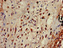 Immunohistochemistry of paraffin-embedded human lung cancer using CAC14813 at dilution of 1:100 Immunohistochemistry of paraffin-embedded human lung cancer using CAC14813 at dilution of 1:100