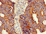 Immunohistochemistry of paraffin-embedded human colon cancer using CAC14815 at dilution of 1:100 Immunohistochemistry of paraffin-embedded human colon cancer using CAC14815 at dilution of 1:100