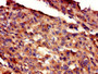 Immunohistochemistry of paraffin-embedded human melanoma using CAC14834 at dilution of 1:100 Immunohistochemistry of paraffin-embedded human melanoma using CAC14834 at dilution of 1:100