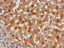 Immunohistochemistry of paraffin-embedded human liver cancer using CAC14872 at dilution of 1:100