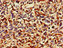 Immunohistochemistry of paraffin-embedded human melanoma using CAC14878 at dilution of 1:100