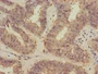 Immunohistochemistry of paraffin-embedded human endometrial cancer using CAC14886 at dilution of 1:100