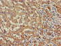 Immunohistochemistry of paraffin-embedded human liver cancer using CAC14888 at dilution of 1:100