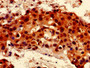 Immunohistochemistry of paraffin-embedded human breast cancer using CAC14895 at dilution of 1:100