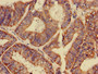 Immunohistochemistry of paraffin-embedded human endometrial cancer using CAC14927 at dilution of 1:100 Immunohistochemistry of paraffin-embedded human endometrial cancer using CAC14927 at dilution of 1:100