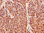 Immunohistochemistry of paraffin-embedded human ovarian cancer using CAC14963 at dilution of 1:100 Immunohistochemistry of paraffin-embedded human ovarian cancer using CAC14963 at dilution of 1:100