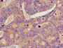 Immunohistochemistry of paraffin-embedded human colon cancer using CAC14981 at dilution of 1:100