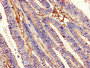 Immunohistochemistry of paraffin-embedded human colon cancer using CAC14984 at dilution of 1:100 Immunohistochemistry of paraffin-embedded human colon cancer using CAC14984 at dilution of 1:100