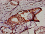 IHC image of CAC14994 diluted at 1:500 and staining in paraffin-embedded human breast cancer performed on a Leica BondTM system. After dewaxing and hydration, antigen retrieval was mediated by high pressure in a citrate buffer (pH 6.0). Section was blocked with 10% normal goat serum 30min at RT. Then primary antibody (1% BSA) was incubated at 4°C overnight. The primary is detected by a biotinylated secondary antibody and visualized using an HRP conjugated SP system.