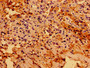 Immunohistochemistry of paraffin-embedded human cervical cancer using CAC15009 at dilution of 1:100 Immunohistochemistry of paraffin-embedded human cervical cancer using CAC15009 at dilution of 1:100