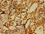 Immunohistochemistry of paraffin-embedded human breast cancer using CAC15029 at dilution of 1:100 Immunohistochemistry of paraffin-embedded human breast cancer using CAC15029 at dilution of 1:100