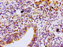 Immunohistochemistry of paraffin-embedded human lung cancer using CAC15071 at dilution of 1:100