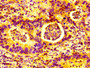 IHC image of CAC15127 diluted at 1:100 and staining in paraffin-embedded human bladder cancer performed on a Leica BondTM system. After dewaxing and hydration, antigen retrieval was mediated by high pressure in a citrate buffer (pH 6.0). Section was blocked with 10% normal goat serum 30min at RT. Then primary antibody (1% BSA) was incubated at 4°C overnight. The primary is detected by a biotinylated secondary antibody and visualized using an HRP conjugated SP system.