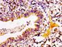 IHC image of CAC15145 diluted at 1:100 and staining in paraffin-embedded human lung cancer performed on a Leica BondTM system. After dewaxing and hydration, antigen retrieval was mediated by high pressure in a citrate buffer (pH 6.0). Section was blocked with 10% normal goat serum 30min at RT. Then primary antibody (1% BSA) was incubated at 4°C overnight. The primary is detected by a biotinylated secondary antibody and visualized using an HRP conjugated SP system.