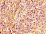 IHC image of CAC15156 diluted at 1:100 and staining in paraffin-embedded human colon cancer performed on a Leica BondTM system. After dewaxing and hydration, antigen retrieval was mediated by high pressure in a citrate buffer (pH 6.0). Section was blocked with 10% normal goat serum 30min at RT. Then primary antibody (1% BSA) was incubated at 4°C overnight. The primary is detected by a biotinylated secondary antibody and visualized using an HRP conjugated SP system.