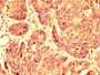 IHC image of CAC15158 diluted at 1:500 and staining in paraffin-embedded human gastric cancer performed on a Leica BondTM system. After dewaxing and hydration, antigen retrieval was mediated by high pressure in a citrate buffer (pH 6.0). Section was blocked with 10% normal goat serum 30min at RT. Then primary antibody (1% BSA) was incubated at 4°C overnight. The primary is detected by a biotinylated secondary antibody and visualized using an HRP conjugated SP system.