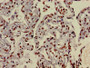 Immunohistochemistry of paraffin-embedded human lung cancer using CAC15165 at dilution of 1:100