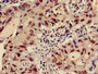 Immunohistochemistry of paraffin-embedded human lung cancer using CAC15166 at dilution of 1:100 Immunohistochemistry of paraffin-embedded human lung cancer using CAC15166 at dilution of 1:100