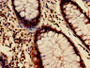 Immunohistochemistry of paraffin-embedded human colon cancer using CAC15168 at dilution of 1:100