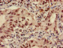 Immunohistochemistry of paraffin-embedded human lung cancer using CAC15168 at dilution of 1:100