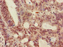 Immunohistochemistry of paraffin-embedded human colon cancer using CAC15176 at dilution of 1:100 Immunohistochemistry of paraffin-embedded human colon cancer using CAC15176 at dilution of 1:100