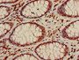 Immunohistochemistry of paraffin-embedded human colon cancer using CAC15183 at dilution of 1:100