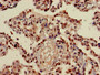 Immunohistochemistry of paraffin-embedded human lung cancer using CAC15183 at dilution of 1:100